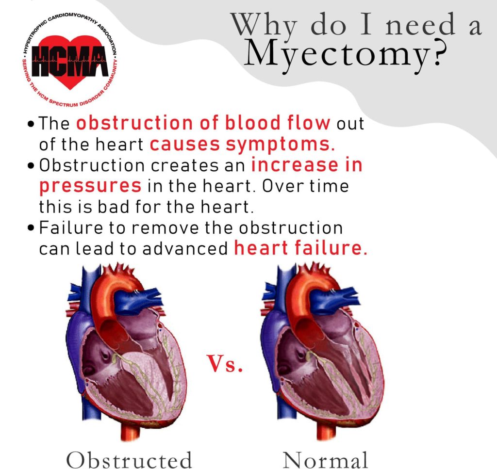 Myectomy - Hypertrophic Cardiomyopathy Association