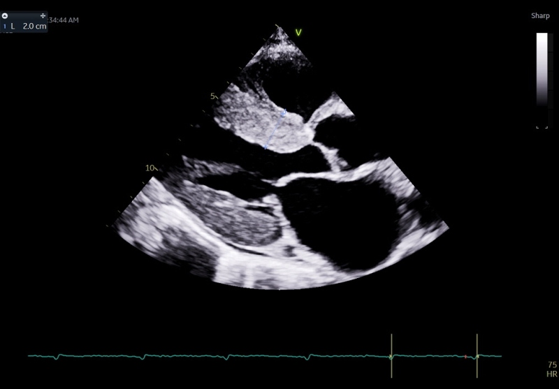Figure 2 - The parasternal long-axis view of a transthoracic echocardiogram shows a thickened bright myocardium, which is often the first clue towards the diagnosis of cardiac amyloidosis. This patient had a low voltage ECG despite thickened myocardium, as shown in Figure 1. Contributed by Pirbhat Shams, MBBS